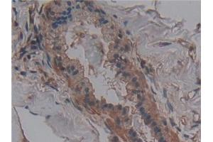 Detection of ANO6 in Human Breast cancer Tissue using Polyclonal Antibody to Anoctamin 6 (ANO6)