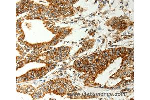 Immunohistochemistry of Human gastic cancer using COX7B Polyclonal Antibody at dilution of 1:70 (COX7B 抗体)