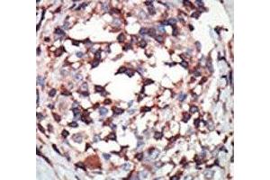 IHC analysis of FFPE human breast carcinoma tissue stained with the PKC beta antibody (PKC beta 抗体  (AA 303-334))