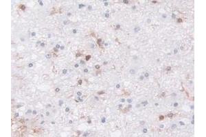 Detection of LCP1 in Human Glioma Tissue using Polyclonal Antibody to L-Plastin (LCP1) (LCP1 抗体  (AA 5-233))