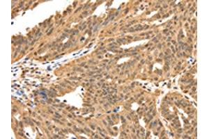 The image on the left is immunohistochemistry of paraffin-embedded Human ovarian cancer tissue using ABIN7192626(SPATA20 Antibody) at dilution 1/70, on the right is treated with synthetic peptide. (SPATA2 抗体)