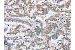 The image on the left is immunohistochemistry of paraffin-embedded Human liver cancer tissue using ABIN7192048(PTGER1 Antibody) at dilution 1/30, on the right is treated with synthetic peptide. (PTGER1 抗体)