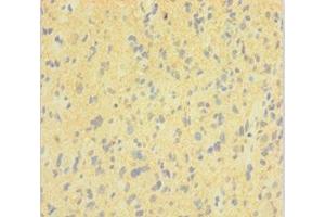 Immunohistochemistry of paraffin-embedded human glioma using ABIN7150825 at dilution of 1:100