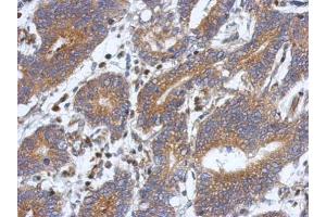 IHC-P Image Immunohistochemical analysis of paraffin-embedded human colon carcinoma, using ATXN10, antibody at 1:500 dilution. (Ataxin 10 抗体)