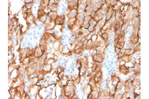 Formalin-fixed, paraffin-embedded human Renal Cell Carcinoma stained with CD10 Mouse Monoclonal Antibody (MME/2579). (MME 抗体  (AA 583-740))