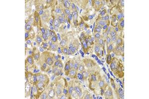 Immunohistochemistry of paraffin-embedded human liver cancer using MAGED1 antibody (ABIN5970448) at dilution of 1/100 (40x lens). (MAGED1 抗体)