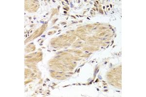 Immunohistochemistry of paraffin-embedded human gastric cancer using CASP2 Antibody. (Caspase 2 抗体)