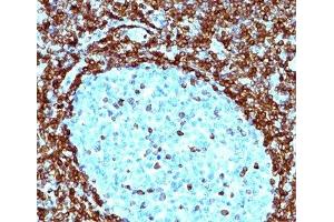 IHC testing of human non-Hodgkin's lymphoma stained with Bcl-2 antibody (124). (Bcl-2 抗体  (AA 41-54))