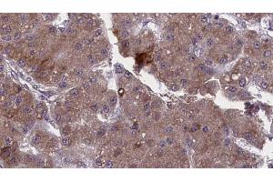 ABIN6272748 at 1/100 staining Human liver cancer tissue by IHC-P. (TAAR1 抗体  (Internal Region))