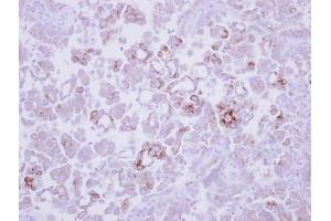 IHC-P Image Immunohistochemical analysis of paraffin-embedded human lung adenocarcinoma, using MMP13, antibody at 1:250 dilution. (MMP13 抗体)