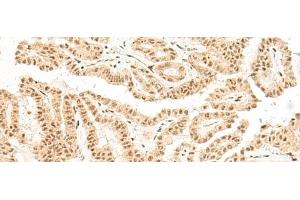 Immunohistochemistry of paraffin-embedded Human thyroid cancer tissue using BICRA Polyclonal Antibody at dilution of 1:40(x200) (BICRA 抗体)