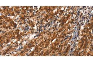 Immunohistochemistry of paraffin-embedded Human gasrtic cancer tissue using CYP2D6 Polyclonal Antibody at dilution 1:40 (CYP2D6 抗体)