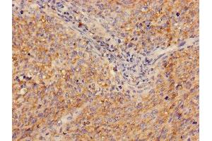 Immunohistochemistry of paraffin-embedded human cervical cancer using ABIN7143283 at dilution of 1:100
