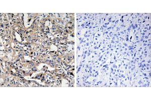 Peptide - +Immunohistochemistry analysis of paraffin-embedded human liver carcinoma tissue using BAX antibody. (BAX 抗体)