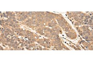 Immunohistochemistry of paraffin-embedded Human thyroid cancer tissue using ZPR1 Polyclonal Antibody at dilution of 1:40(x200) (ZNF259 抗体)