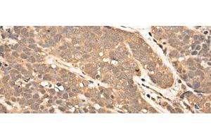 Immunohistochemistry of paraffin-embedded Human thyroid cancer tissue using ZPR1 Polyclonal Antibody at dilution of 1:40(x200) (ZNF259 抗体)