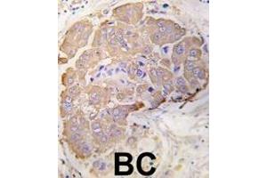 Formalin-fixed and paraffin-embedded human breast carcinoma tissue reacted with HSPB1 Antibody (S82) (ABIN391299 and ABIN2841335) , which was peroxidase-conjugated to the secondary antibody, followed by DAB staining. (HSP27 抗体  (AA 60-89))