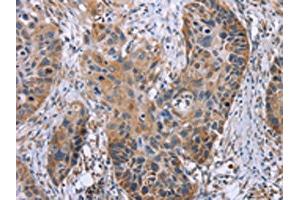 The image on the left is immunohistochemistry of paraffin-embedded Human esophagus cancer tissue using ABIN7130502(OPTN Antibody) at dilution 1/25, on the right is treated with fusion protein. (OPTN 抗体)