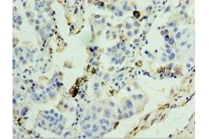 Immunohistochemistry of paraffin-embedded human lung cancer using ABIN7154097 at dilution of 1:100 (GSTA4 抗体  (AA 93-222))