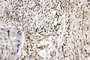 Anti-NOX1 antibody, IHC(P) IHC(P): Human Lung Cancer Tissue (NOX1 抗体  (Middle Region))