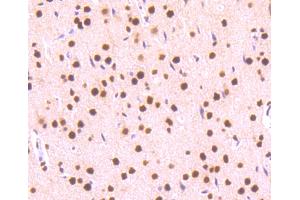 Immunohistochemistry (Paraffin-embedded Sections) (IHC (p)) image for anti-Signal Transducer and Activator of Transcription 3 (Acute-Phase Response Factor) (STAT3) (pSer727) antibody (ABIN5557530)