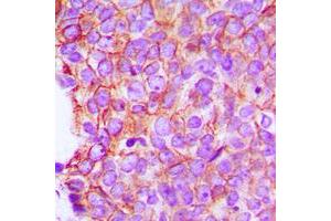 Immunohistochemical analysis of Catenin alpha 1/2 staining in human breast cancer formalin fixed paraffin embedded tissue section. (Catenin alpha 1/2 (C-Term) 抗体)
