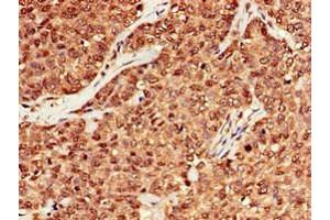 Immunohistochemistry of paraffin-embedded human ovarian cancer using ABIN7150624 at dilution of 1:100 (Mre11 抗体  (AA 1-205))
