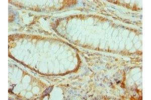 Immunohistochemistry of paraffin-embedded human colon cancer using ABIN7172290 at dilution of 1:100 (TIRAP 抗体  (AA 1-221))
