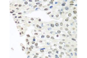 Immunohistochemistry of paraffin-embedded Human prostate cancer using TARDBP Polyclonal Antibody at dilution of 1:100 (40x lens).