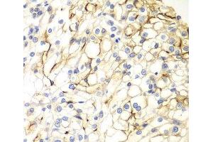 Immunohistochemistry of paraffin-embedded Human kidney cancer using VANGL2 Polyclonal Antibody at dilution of 1:100 (40x lens).