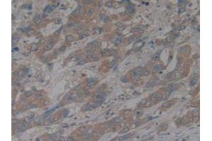 IHC-P analysis of Human Breast Cancer Tissue, with DAB staining. (CX3CL1 抗体  (AA 25-332))