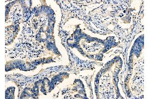 ABIN6263397 and ABIN6278053 at 1/100 staining Human prostate cancer by IHC-P.