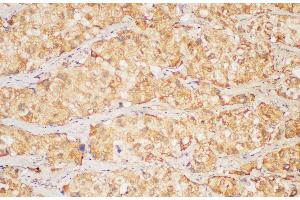 Immunohistochemistry of paraffin-embedded Human liver cancer using FGB Polycloanl Antibody at dilution of 1:200 (Fibrinogen beta Chain 抗体)