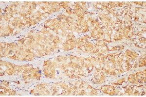 Immunohistochemistry of paraffin-embedded Human liver cancer using FGB Polycloanl Antibody at dilution of 1:200