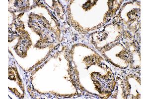 GAPDH was detected in paraffin-embedded sections of human thyroid cancer tissues using rabbit anti- GAPDH Antigen Affinity purified polyclonal antibody (Catalog # ) at 1 µg/mL. (GAPDH 抗体  (AA 136-335))