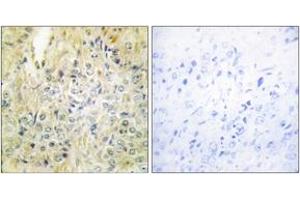 Immunohistochemistry analysis of paraffin-embedded human prostate carcinoma tissue, using DLEC1 Antibody.