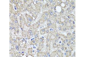 Immunohistochemistry of paraffin-embedded Human liver damage using MUC16 Polyclonal Antibody at dilution of 1:100 (40x lens). (MUC16 抗体)