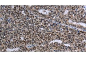 Immunohistochemistry of paraffin-embedded Human ovarian cancer tissue using MAGEC1 Polyclonal Antibody at dilution 1:30 (MAGEC1 抗体)