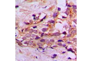 Immunohistochemical analysis of DYNLL2 staining in human breast cancer formalin fixed paraffin embedded tissue section.