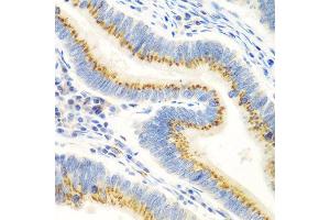 Immunohistochemistry of paraffin-embedded human colon carcinoma using UBIAD1 antibody at dilution of 1:100 (40x lens). (UBIAD1 抗体)