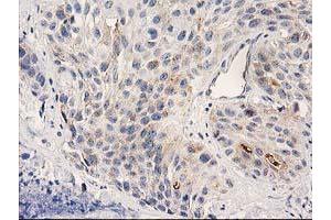 Immunohistochemical staining of paraffin-embedded Carcinoma of Human bladder tissue using anti-PLEKHA3 mouse monoclonal antibody. (PLEKHA3 抗体)