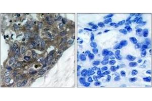 Immunohistochemistry analysis of paraffin-embedded human breast carcinoma tissue, using ASK1 (Ab-966) Antibody. (ASK1 抗体  (AA 932-981))