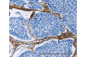 Immunohistochemistry of Human prostate cancer using COL3A1 Polyclonal Antibody at dilution of 1:60 (COL3A1 抗体)