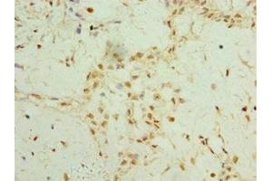 Immunohistochemistry of paraffin-embedded human breast cancer using ABIN7159637 at dilution of 1:100 (TET2 抗体  (AA 1833-2002))