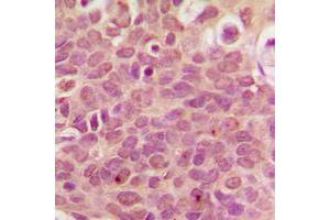 Immunohistochemical analysis of RPL36 staining in human breast cancer formalin fixed paraffin embedded tissue section. (RPL36 抗体  (Center))