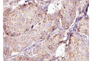 ABIN6277590 at 1/100 staining Human breast cancer tissue by IHC-P. (HSD17B10 抗体  (Internal Region))