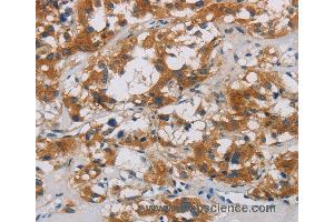 Immunohistochemistry of Human thyroid cancer using CNDP1 Polyclonal Antibody at dilution of 1:30 (CNDP1 抗体)