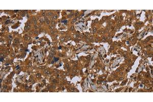 Immunohistochemistry of paraffin-embedded Human liver cancer tissue using SCGB1D2 Polyclonal Antibody at dilution 1:40 (SCGB1D2 抗体)