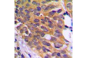 Immunohistochemical analysis of EEF2K (pS366) staining in human prostate cancer formalin fixed paraffin embedded tissue section. (EEF2K 抗体  (pSer366))