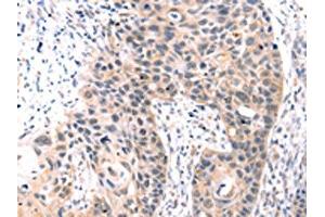 The image on the left is immunohistochemistry of paraffin-embedded Human esophagus cancer tissue using ABIN7192749(TCERG1L Antibody) at dilution 1/30, on the right is treated with synthetic peptide. (TCERG1L 抗体)